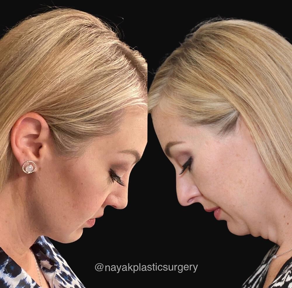 Rhinoplasty Before & After