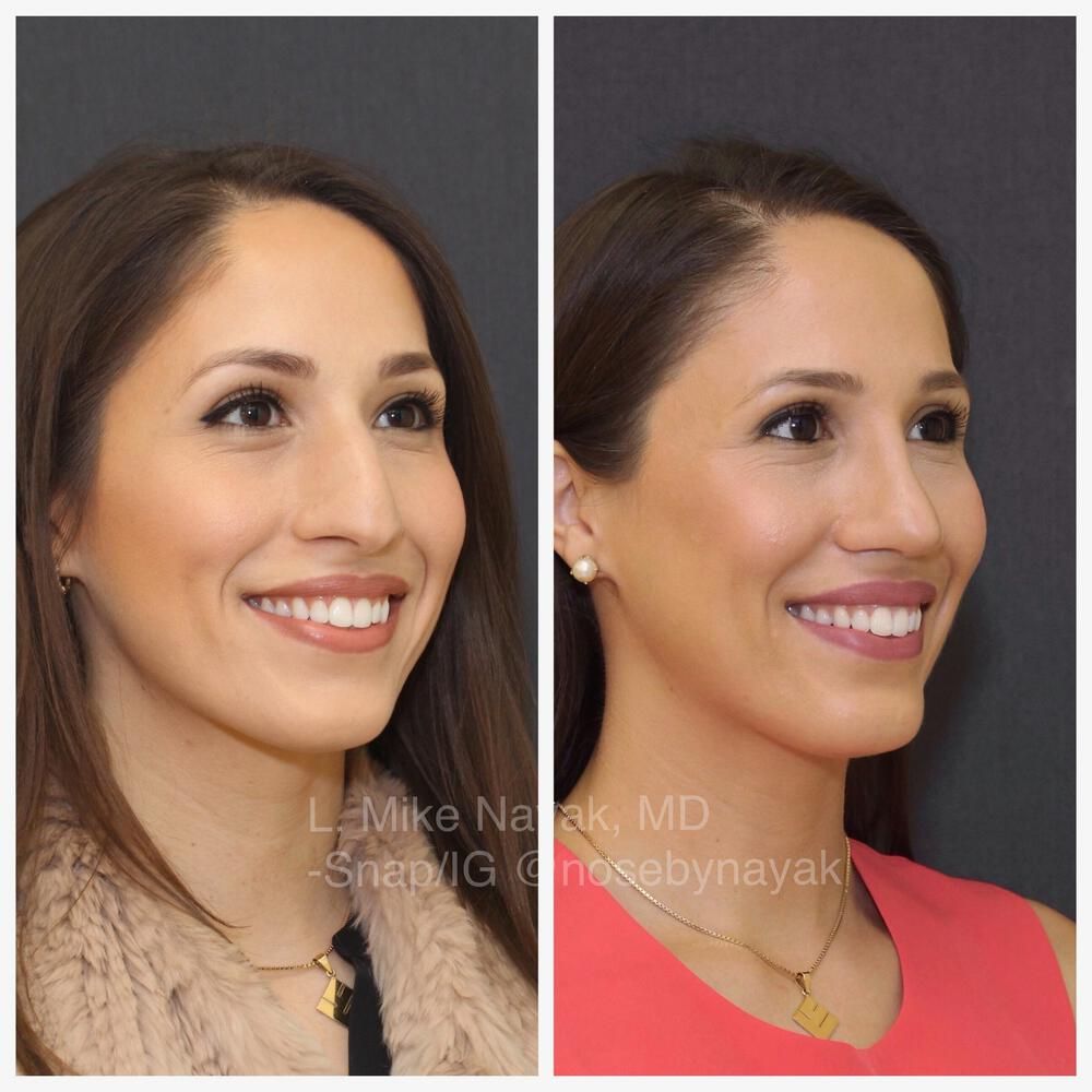 Rhinoplasty Before & After