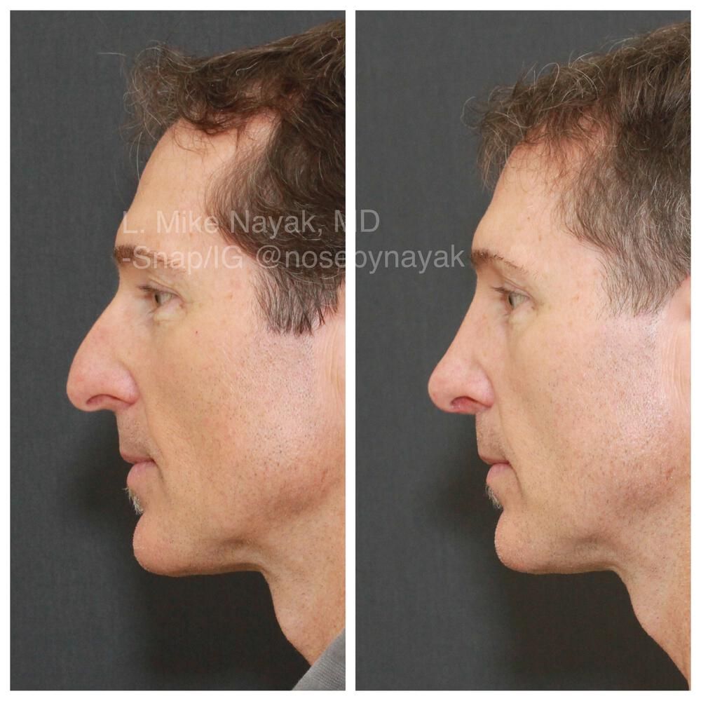 Rhinoplasty Before & After
