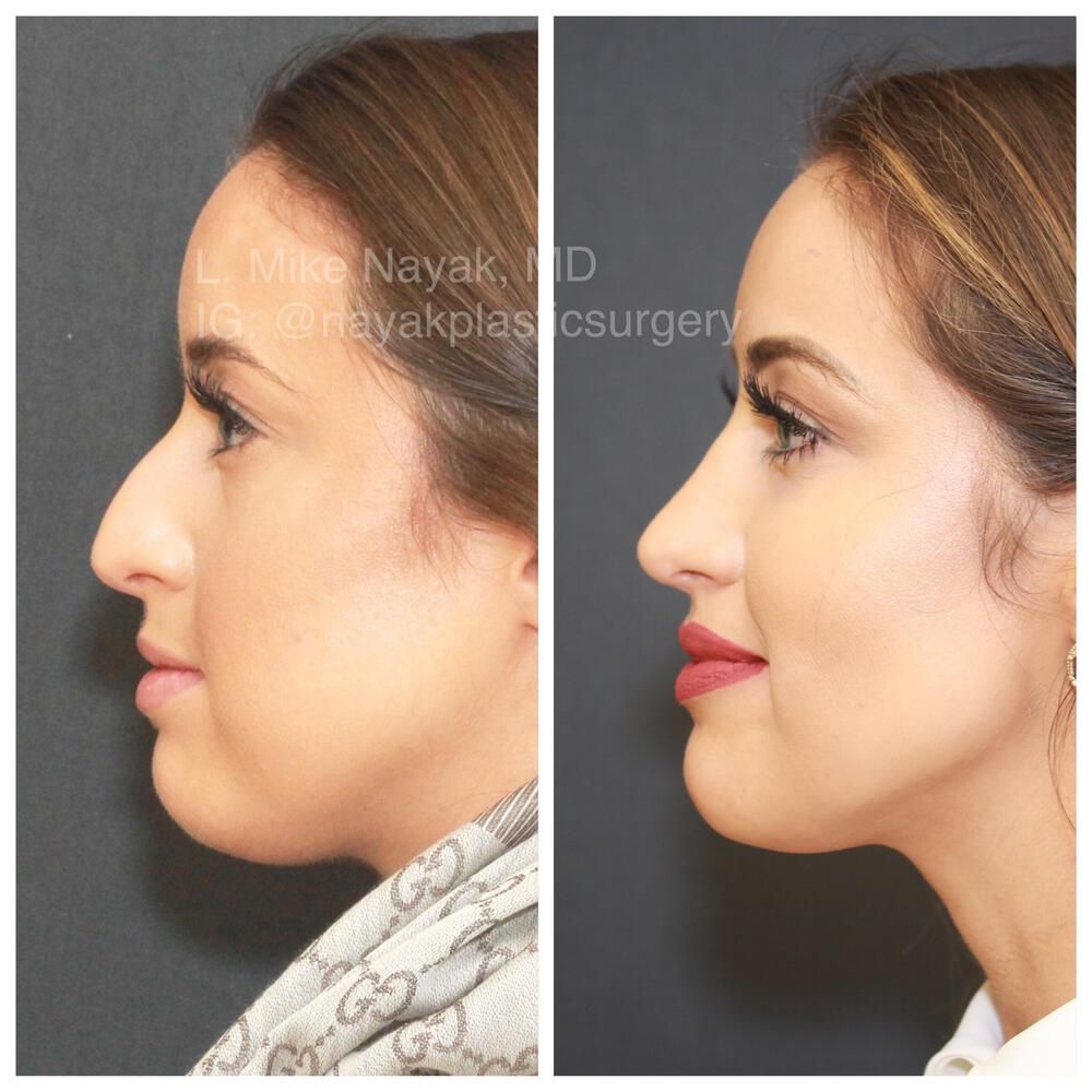 Rhinoplasty Before & After