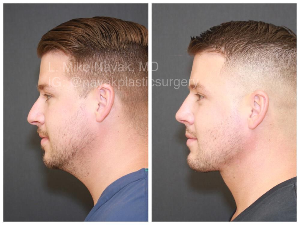 Rhinoplasty Before & After