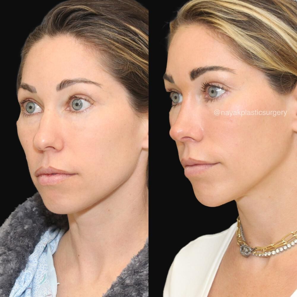 Rhinoplasty Before & After