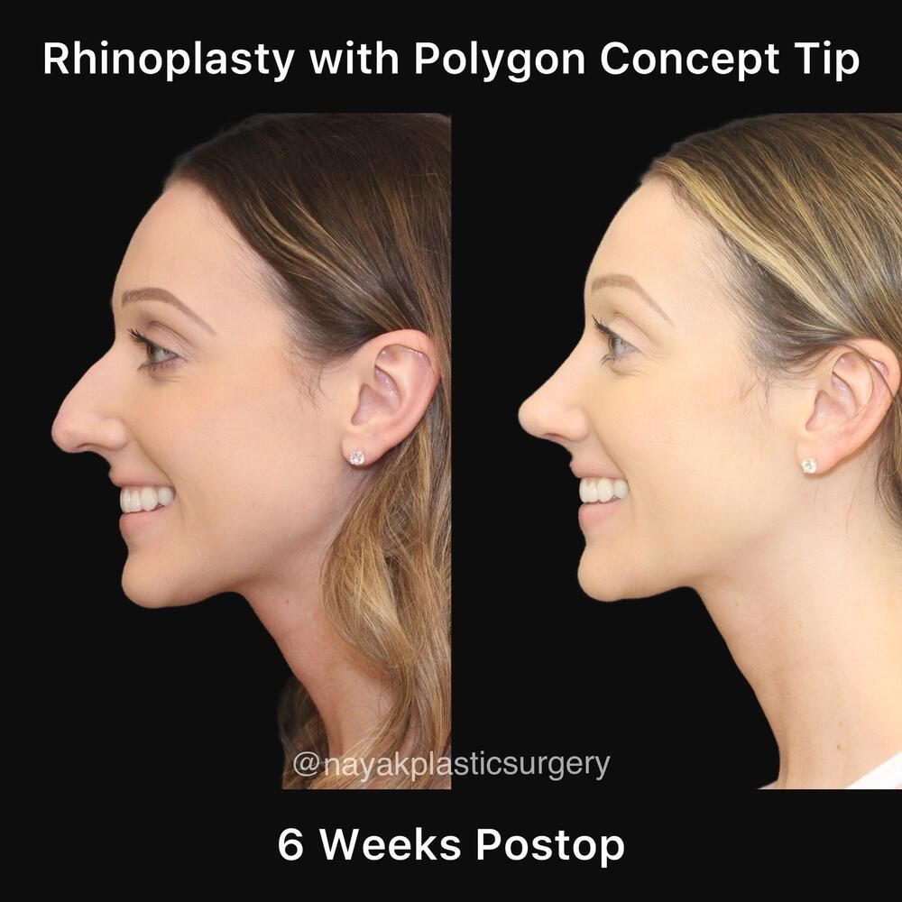 Rhinoplasty Before & After