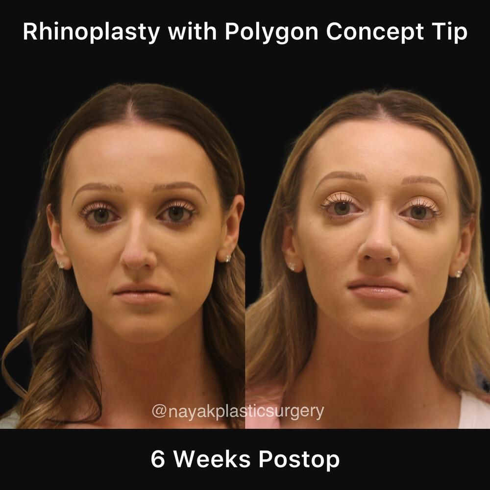 Rhinoplasty Before & After