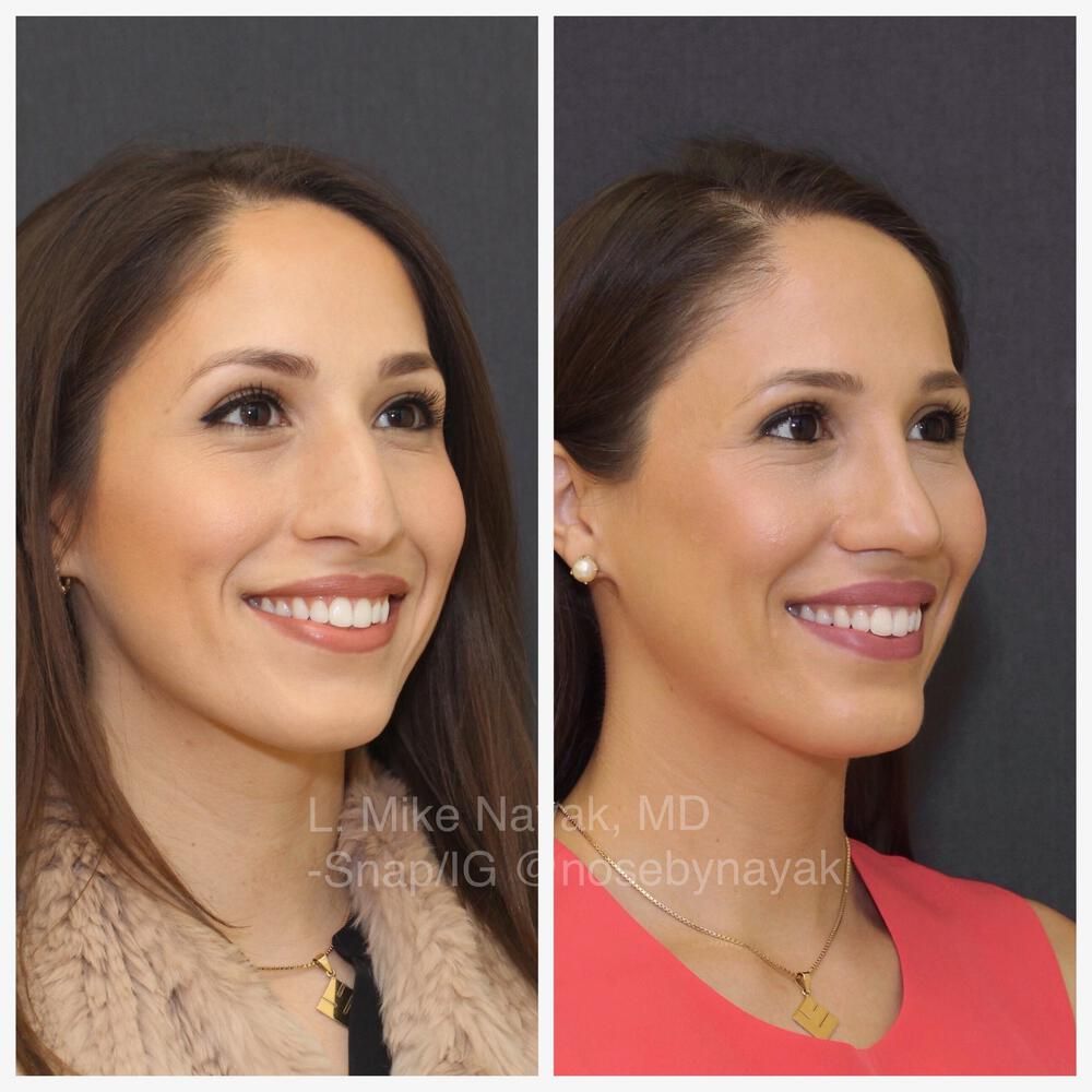 Rhinoplasty Before & After