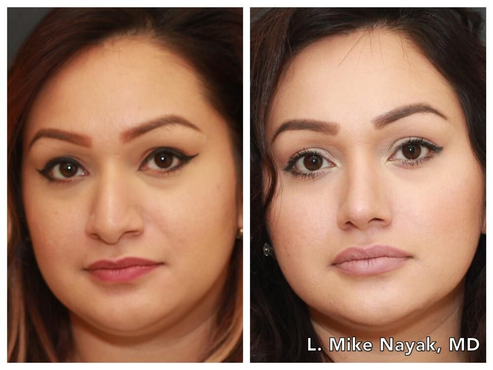 Rhinoplasty Before & After