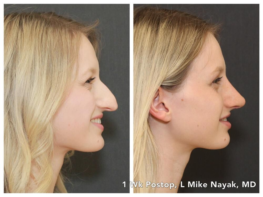 Rhinoplasty Before & After