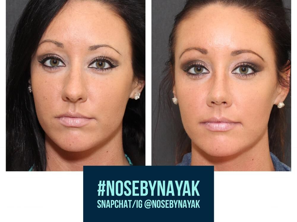 Rhinoplasty Before & After