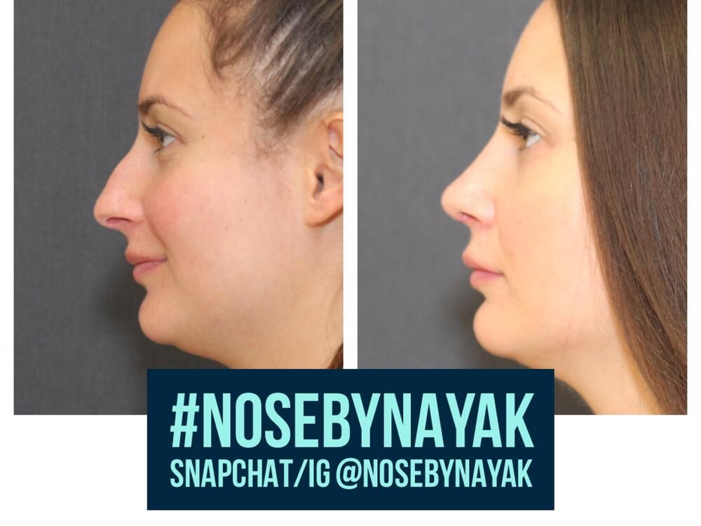 Rhinoplasty Before & After