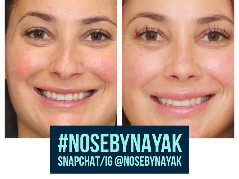 Rhinoplasty Before & After