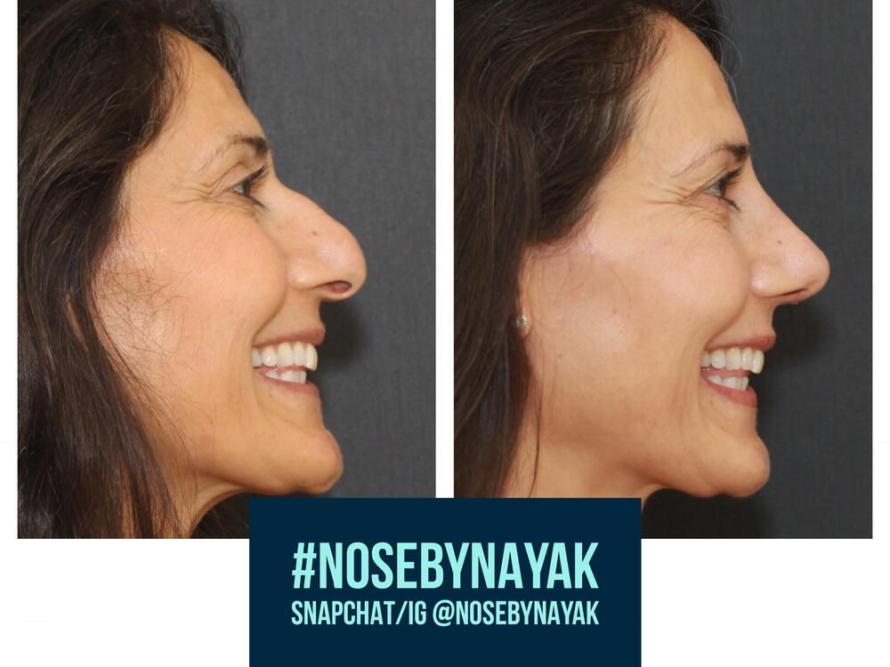 Rhinoplasty Before & After