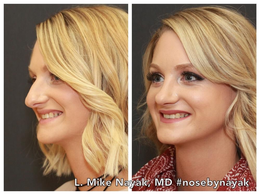 Rhinoplasty Before & After
