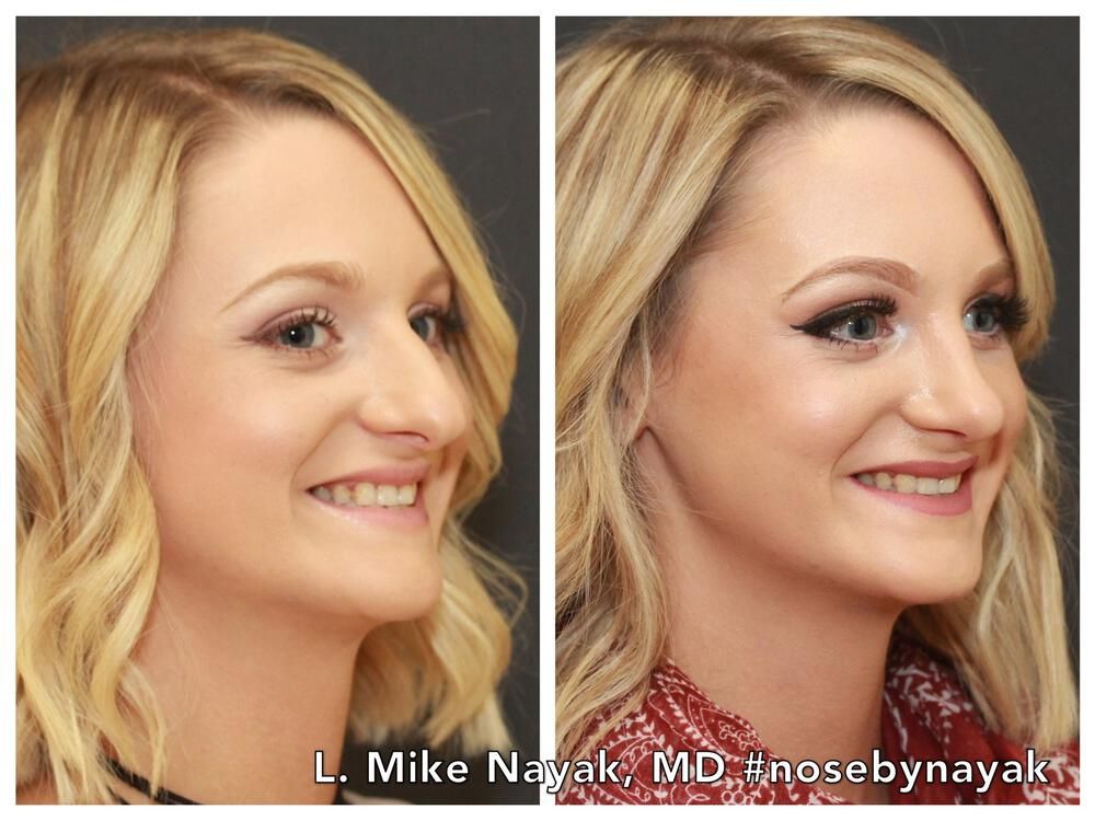 Rhinoplasty Before & After