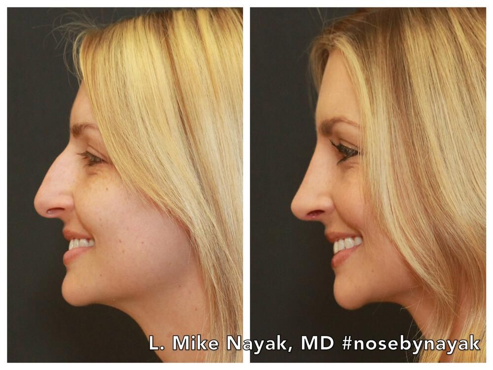 Rhinoplasty Before & After