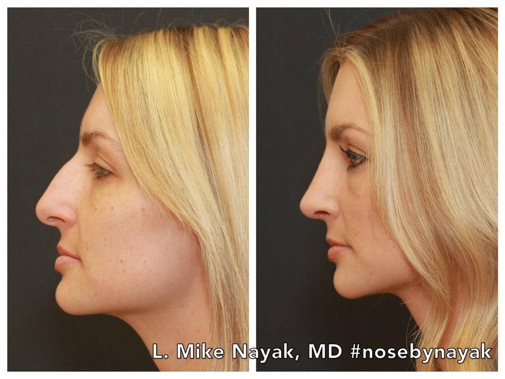 Rhinoplasty Before & After