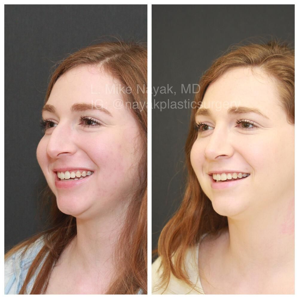 Rhinoplasty Before & After
