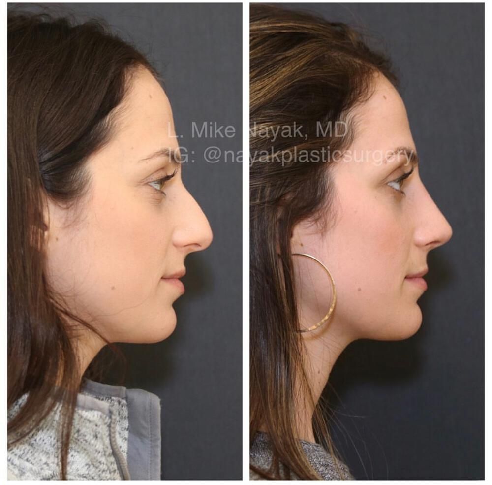 Rhinoplasty Before & After