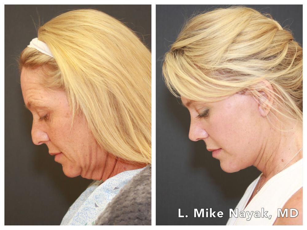 Rhinoplasty Before & After