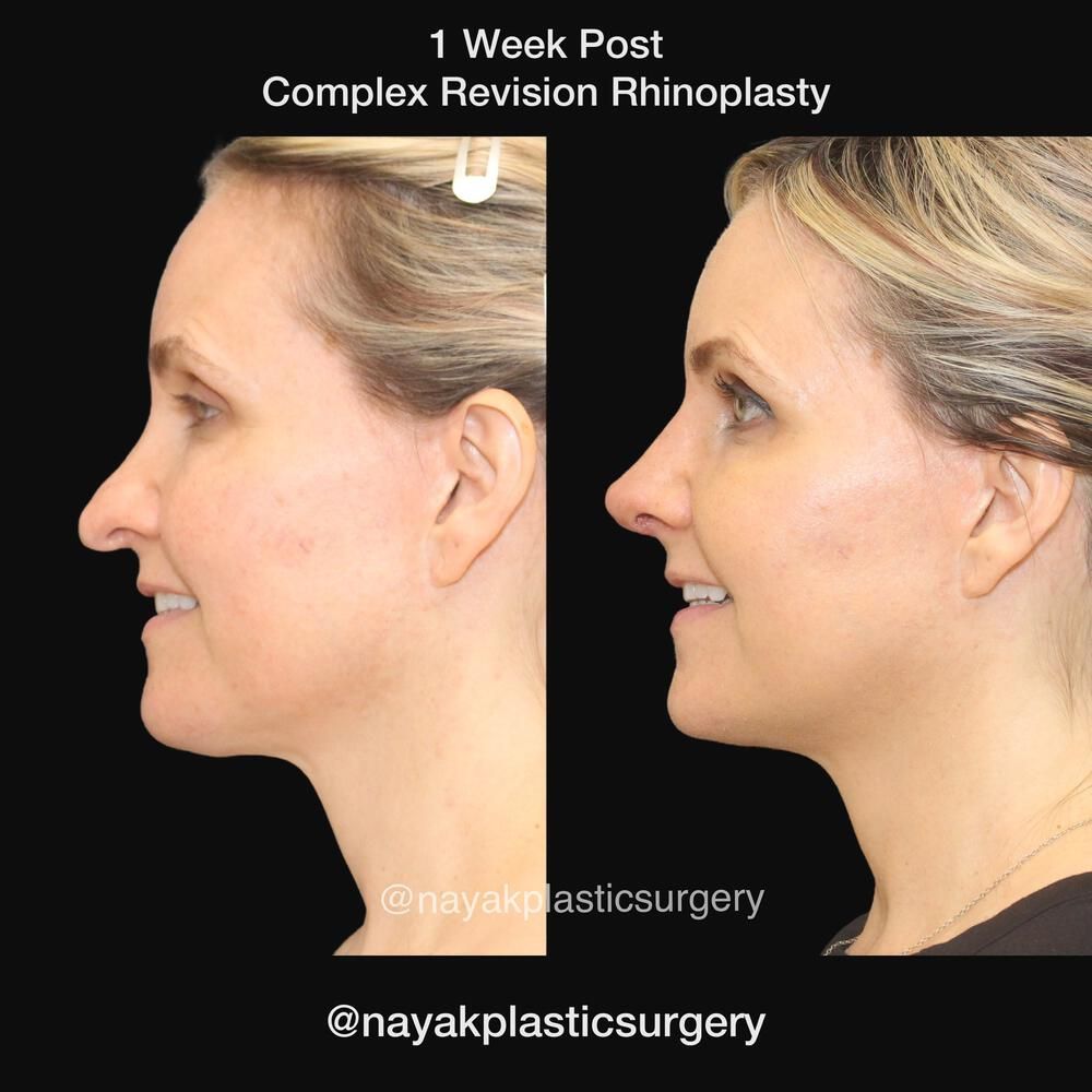 Rhinoplasty Before & After