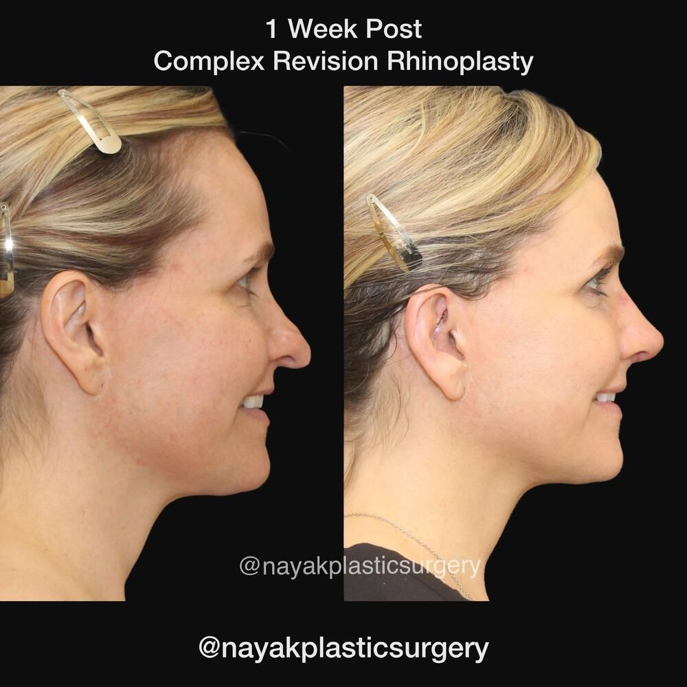 Rhinoplasty Before & After