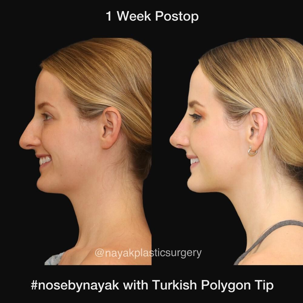 Rhinoplasty Before & After