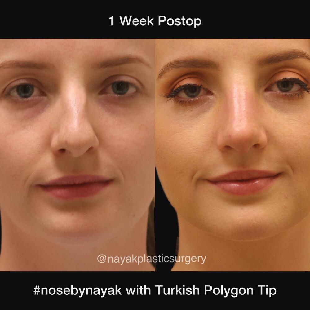 Rhinoplasty Before & After