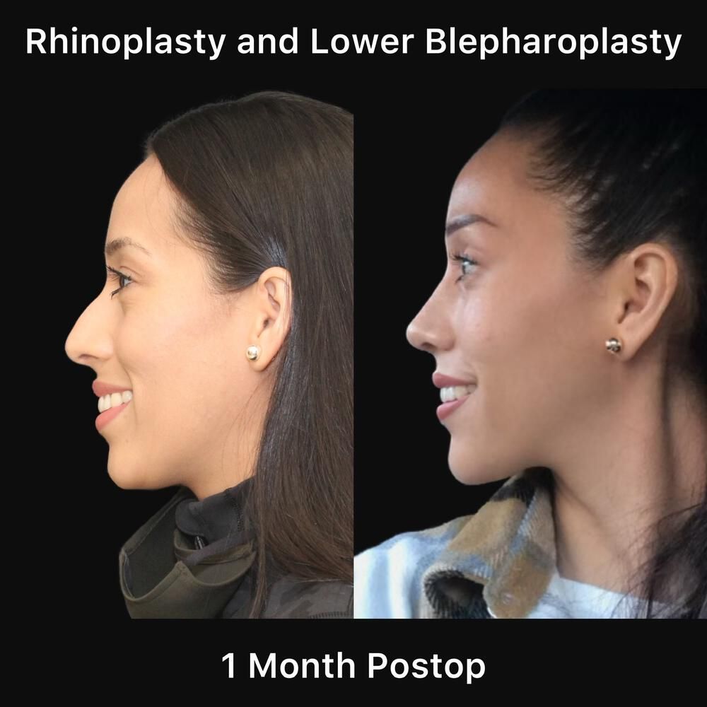 Rhinoplasty Before & After