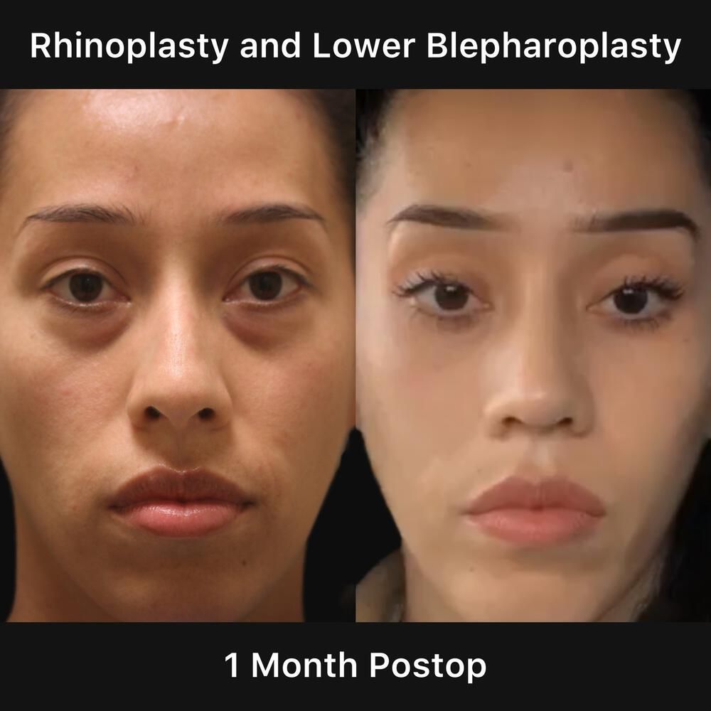 Rhinoplasty Before & After