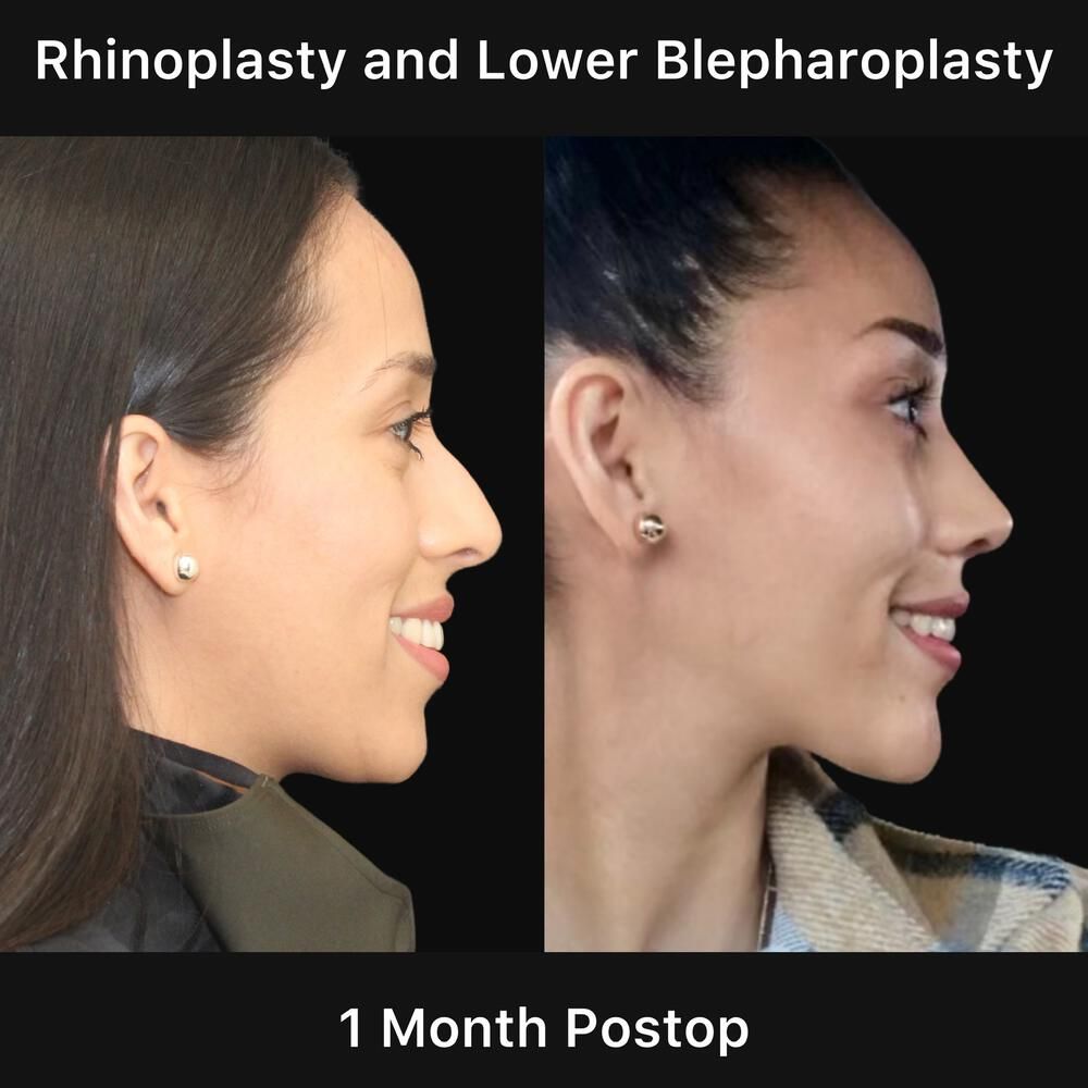 Rhinoplasty Before & After