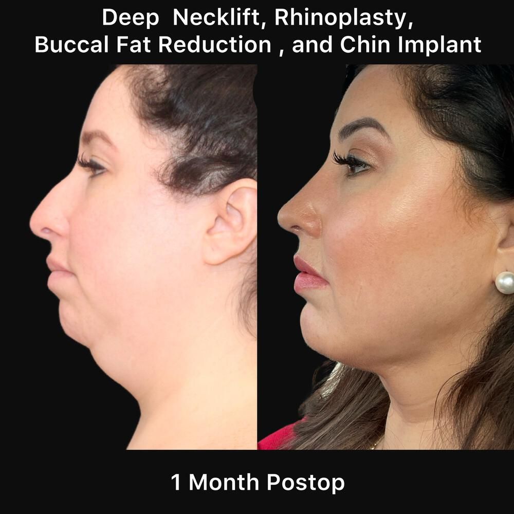 Rhinoplasty Before & After