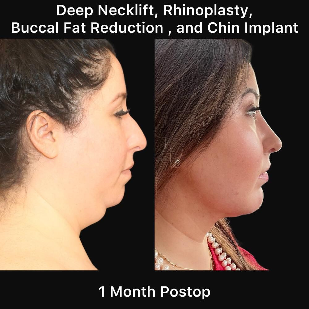 Rhinoplasty Before & After