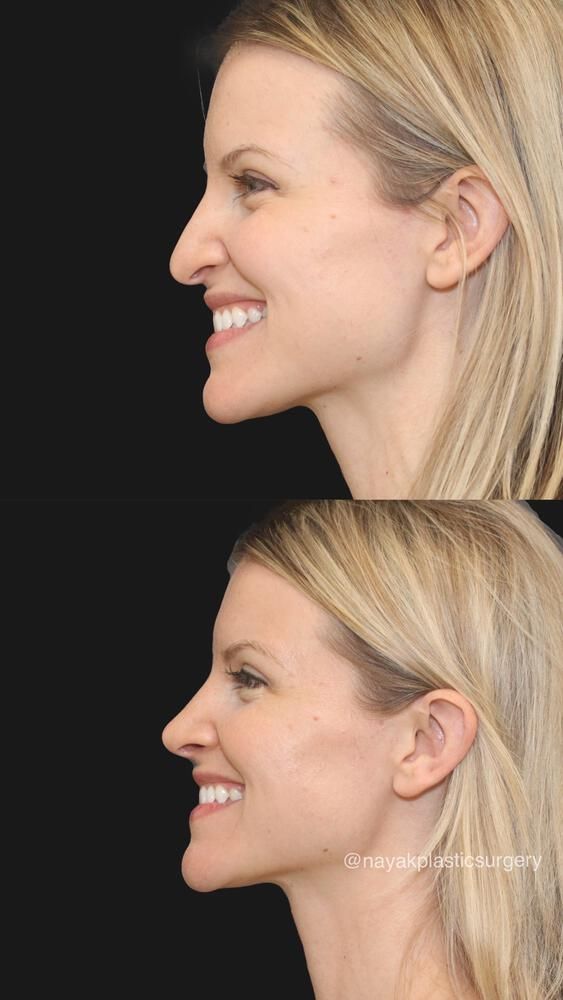 Rhinoplasty Before & After