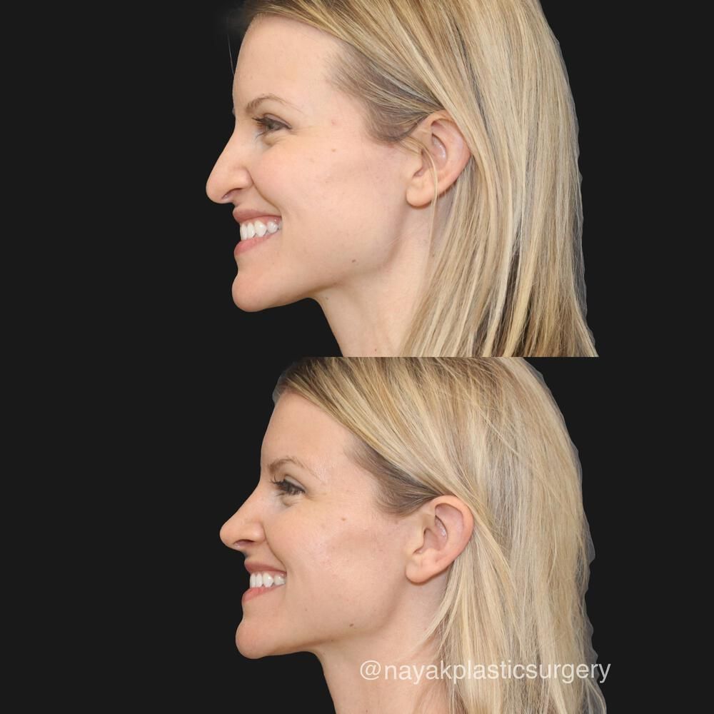 Rhinoplasty Before & After