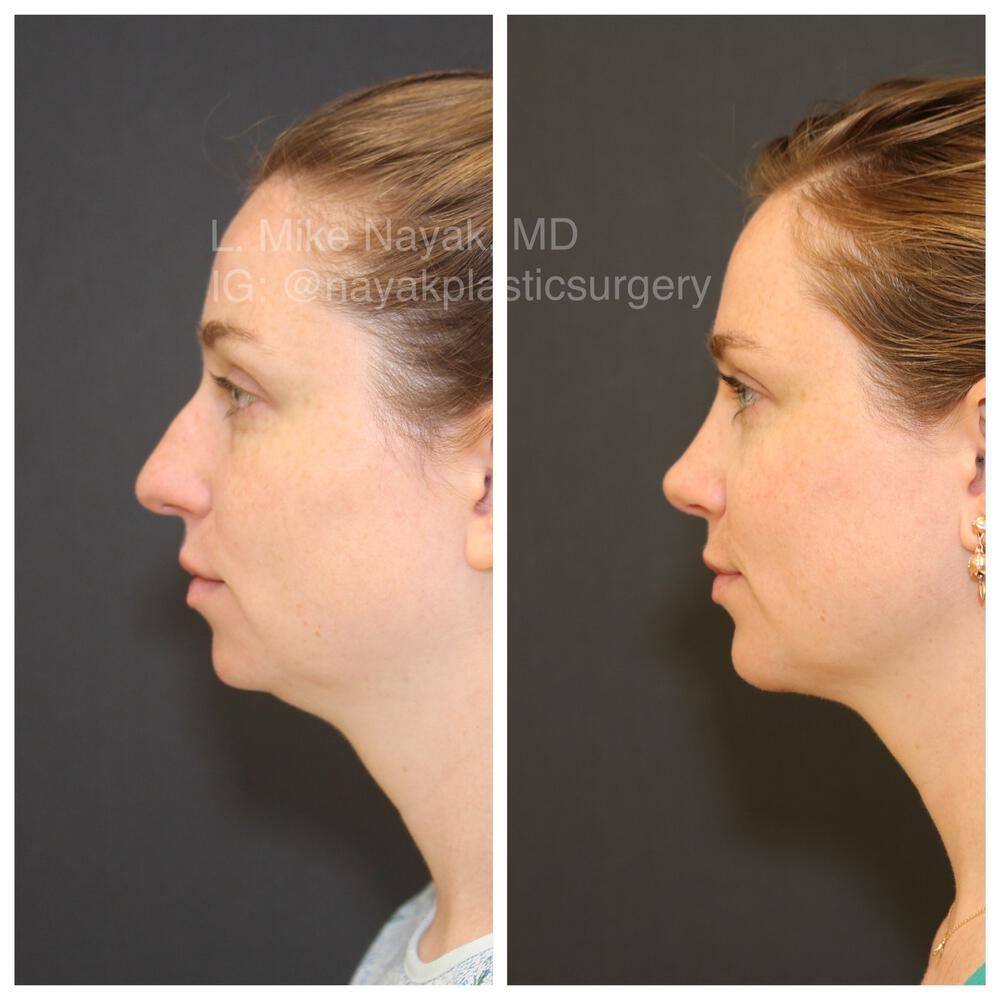 Rhinoplasty Before & After