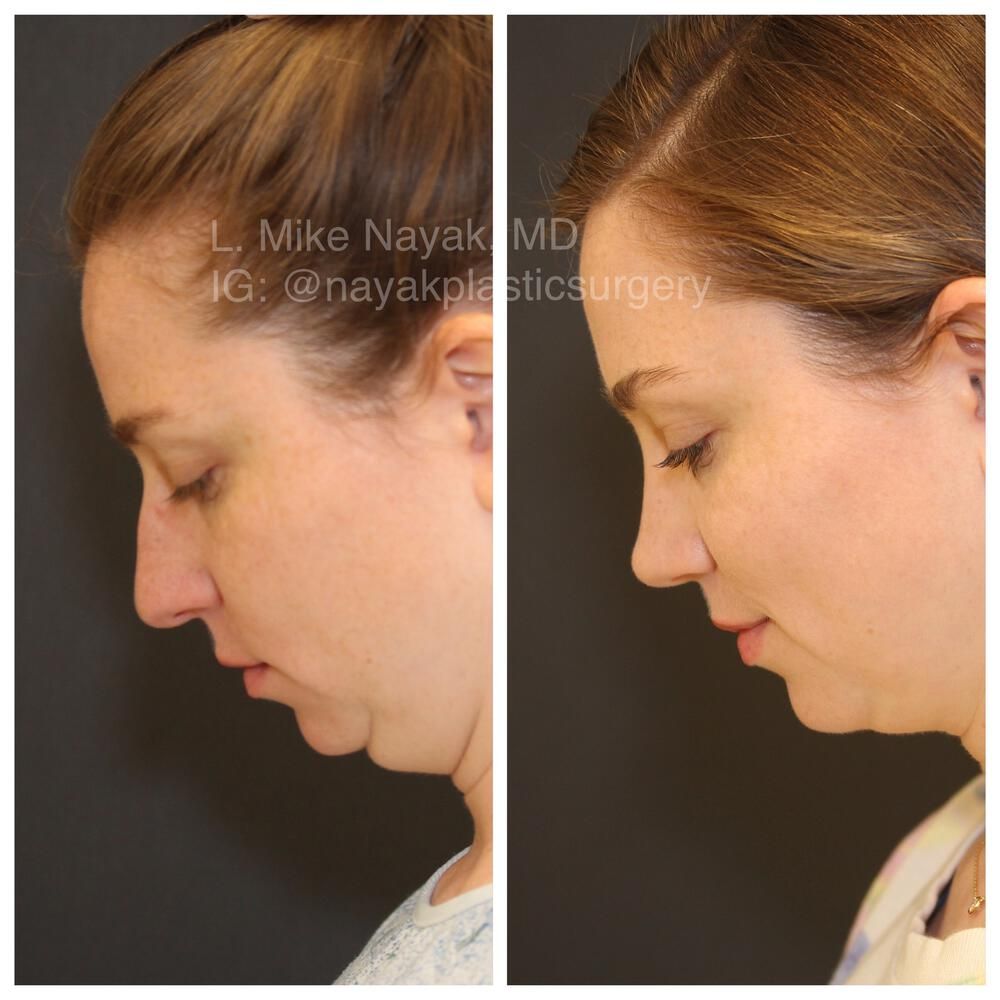 Rhinoplasty Before & After