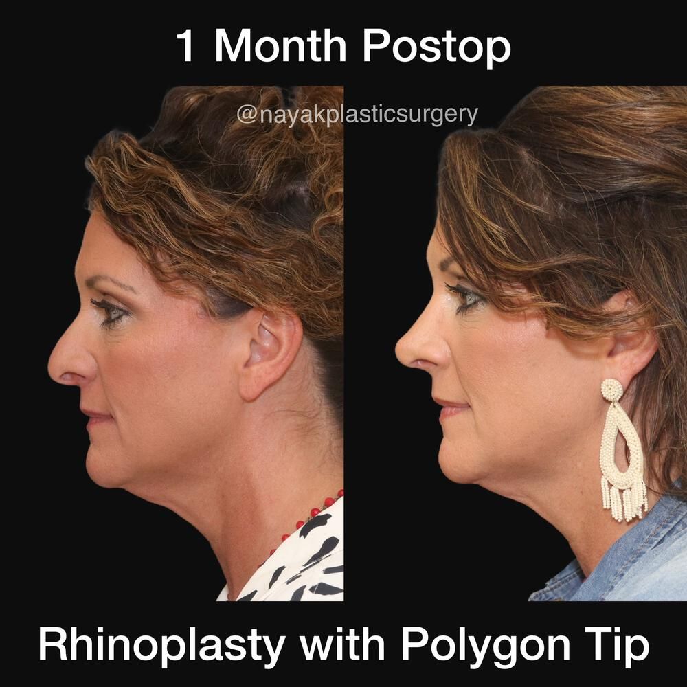 Rhinoplasty Before & After