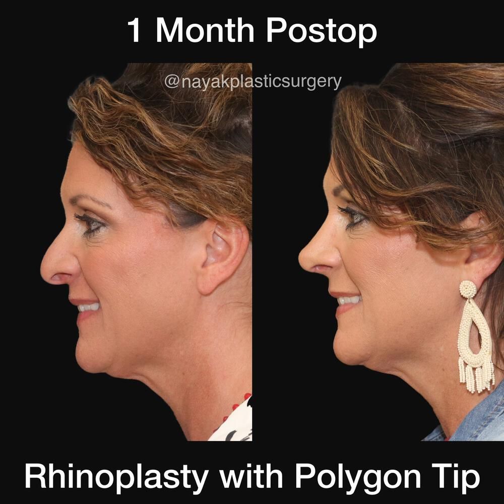Rhinoplasty Before & After