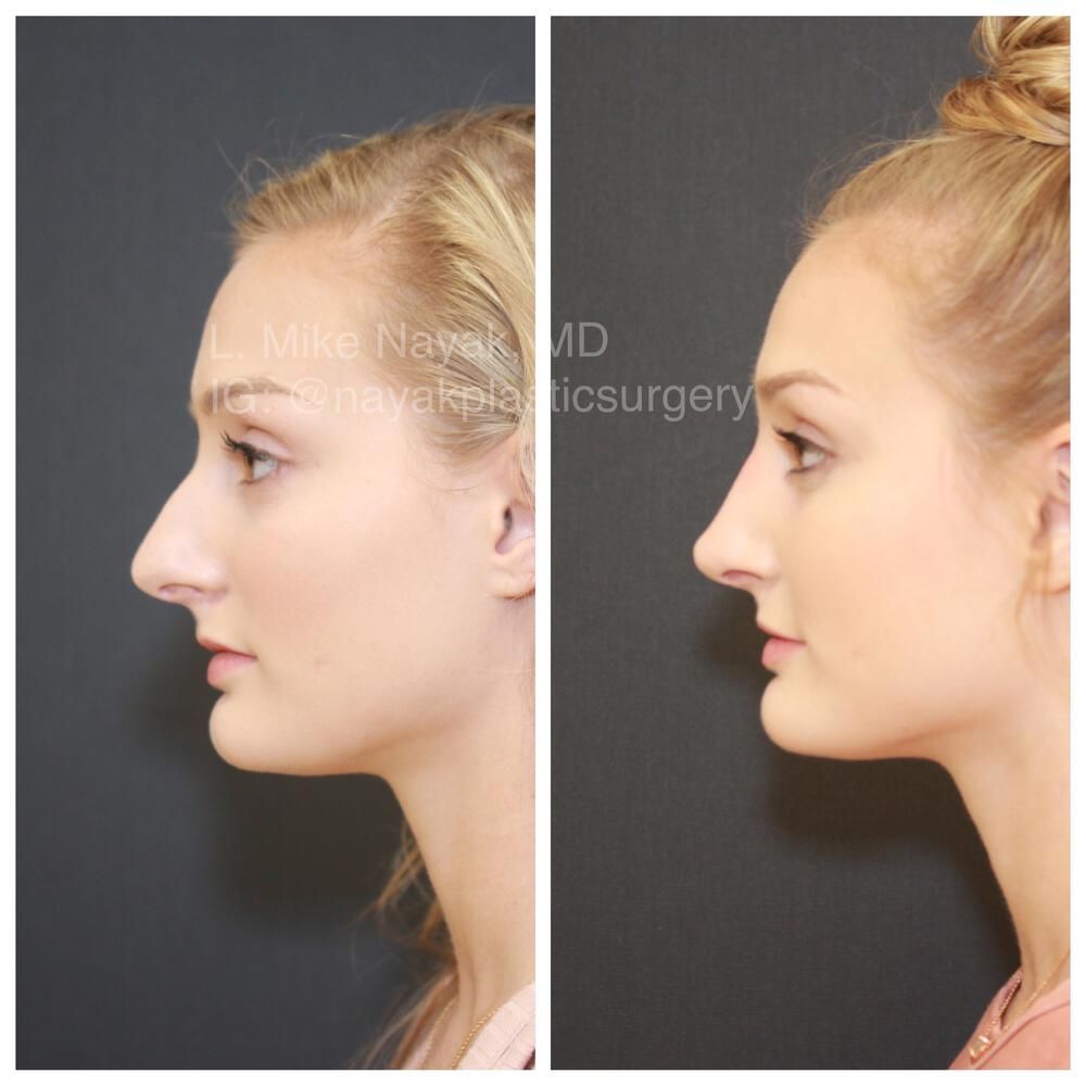Rhinoplasty Before & After