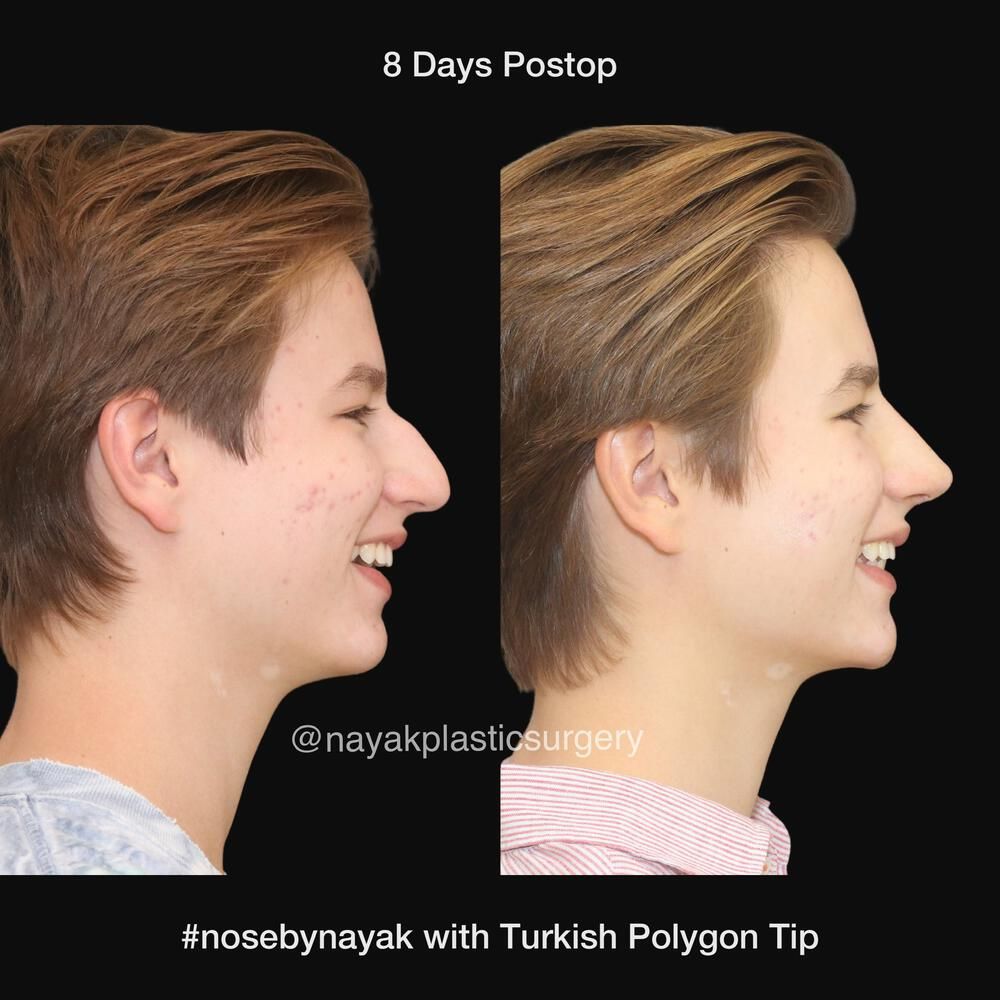 Rhinoplasty Before & After