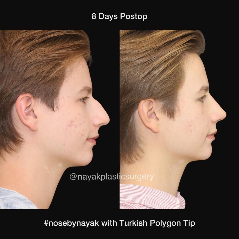 Rhinoplasty Before & After