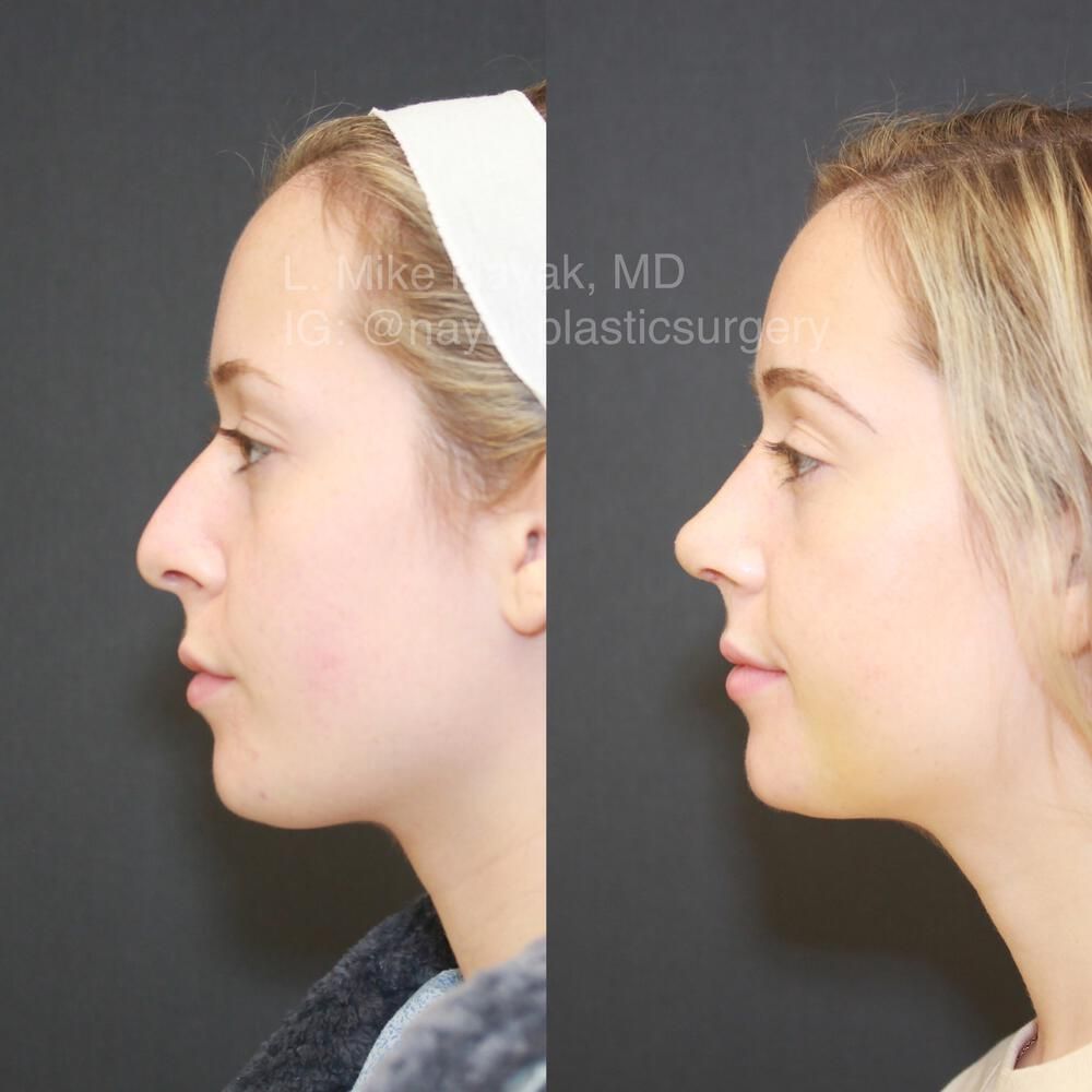 Rhinoplasty Before & After