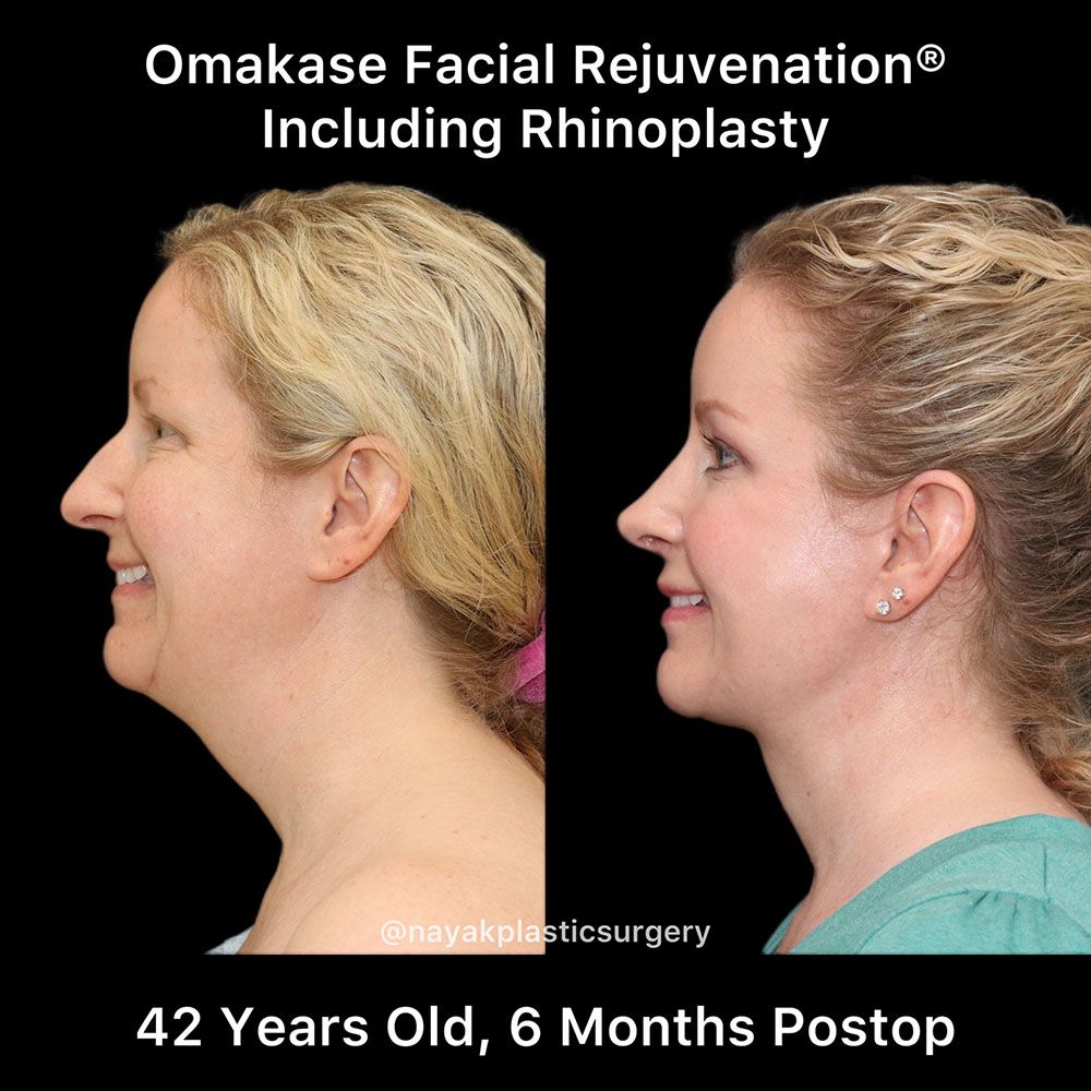 Rhinoplasty Before & After