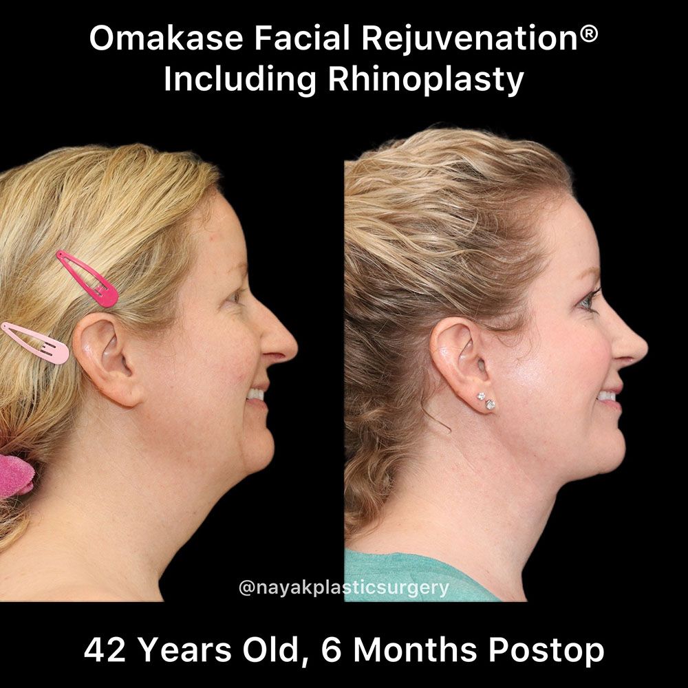Rhinoplasty Before & After