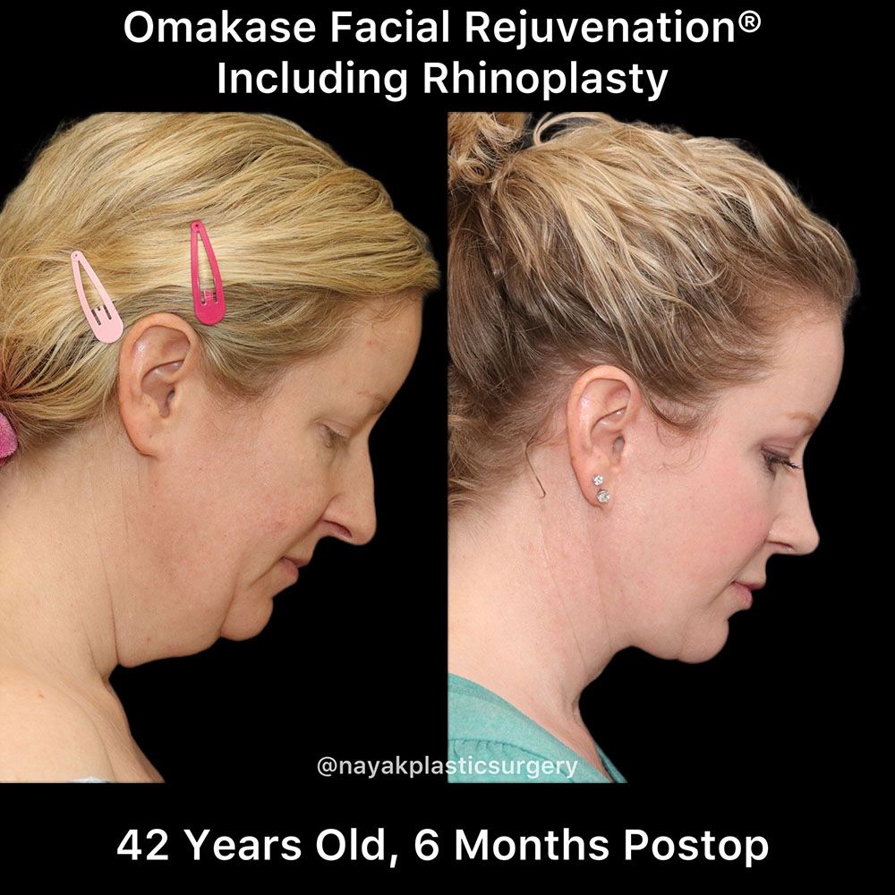 Rhinoplasty Before & After
