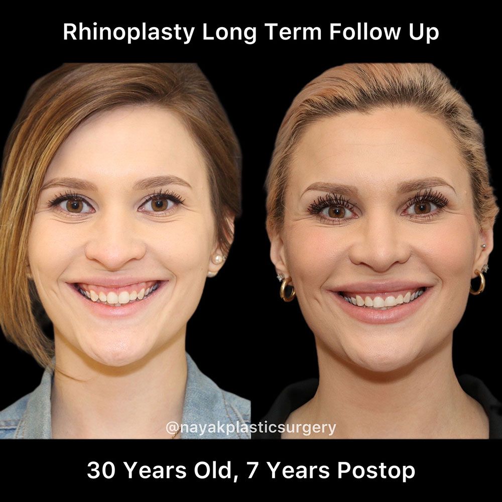 Rhinoplasty Before & After