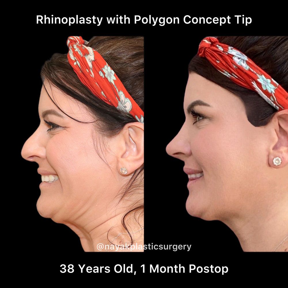 Rhinoplasty Before & After