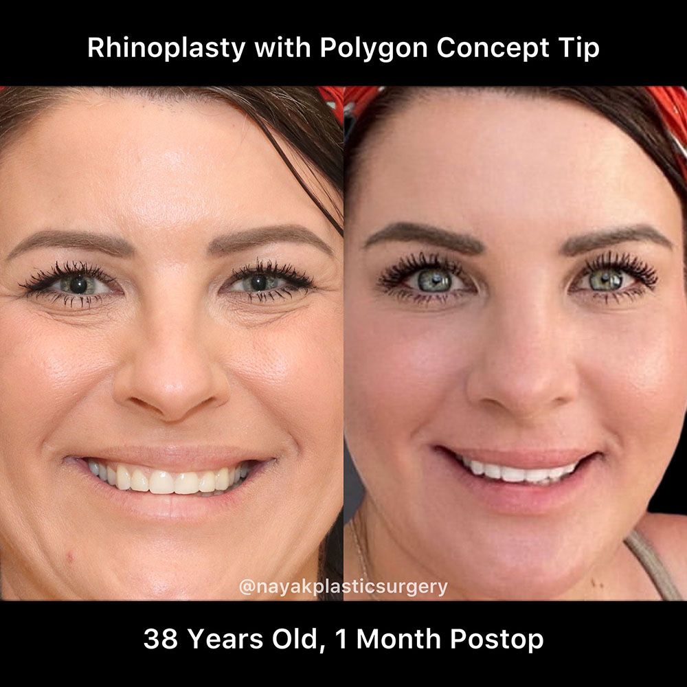 Rhinoplasty Before & After