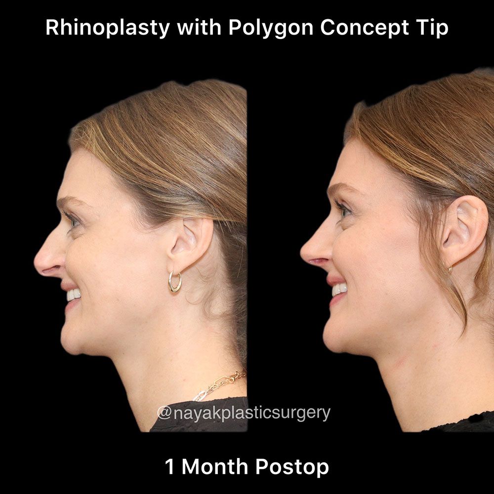 Rhinoplasty Before & After