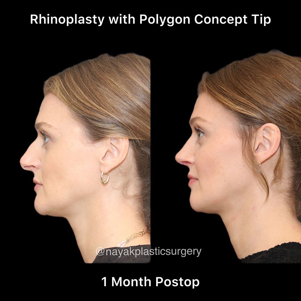 Rhinoplasty Before & After
