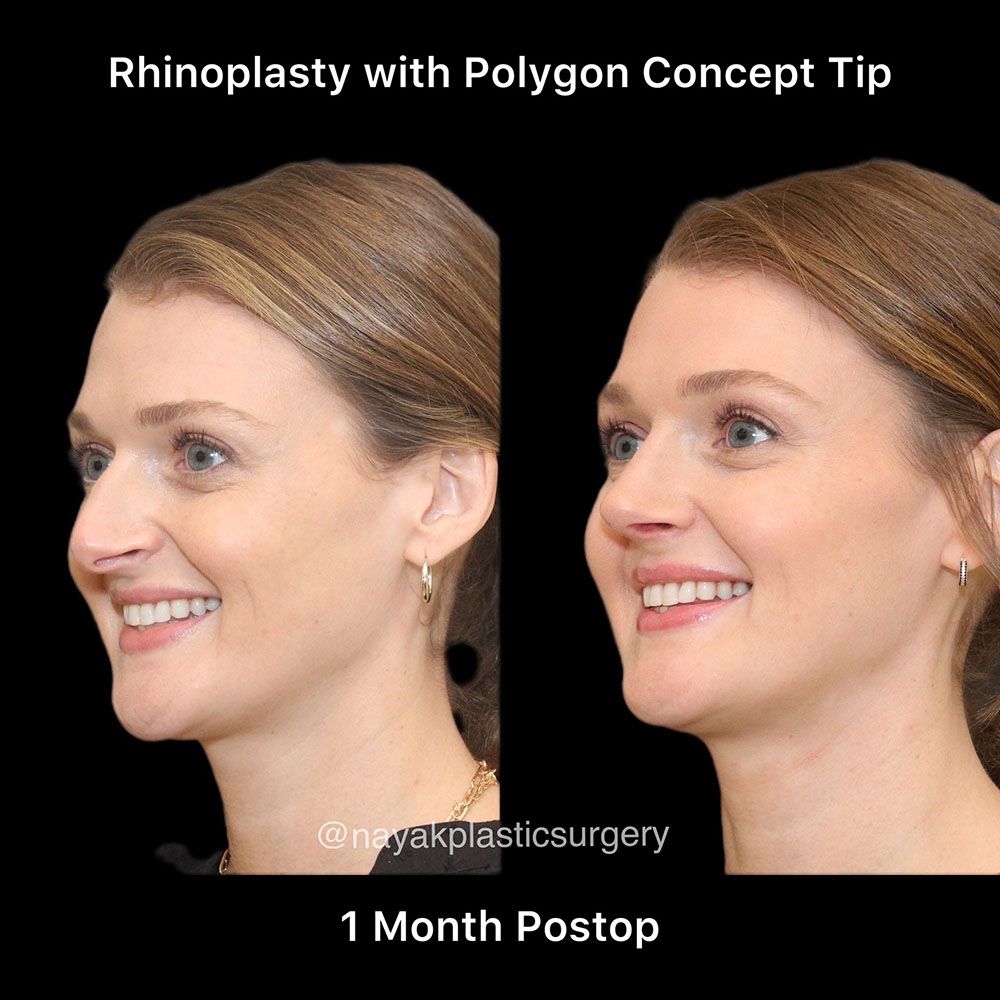 Rhinoplasty Before & After